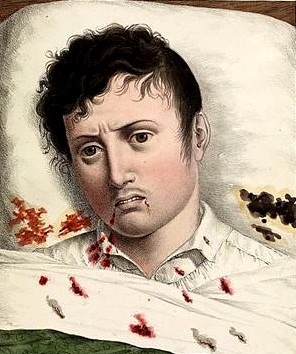 Patient in Late Stage of Yellow Fever